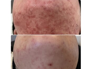 ママナ(mamana)/ニキビにお悩みの方。。