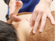 大砂土治療院/肩こり頭痛に鍼灸施術