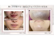 フォフォ 仙台泉店(Fofo)/メンズ髭脱毛