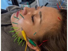 ラムールボーテ(L'AMOUR BEAUTE)/美容鍼