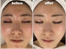 ビビット 久宝寺店(VIVIT)/肌質改善/光フォト/肌回復