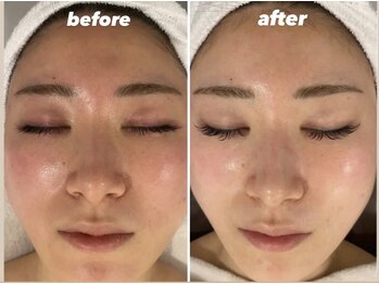 ビビット 久宝寺店(VIVIT)/肌質改善/光フォト/肌回復