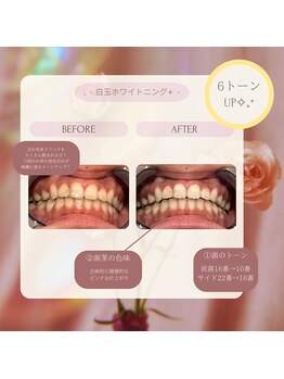 プラスビー 2号店(+b)/ホワイトニングビフォーアフター