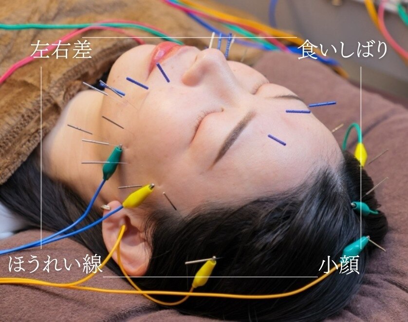 気になるほうれい線に！刺さない美容鍼♥600本　肩こりや足のむくみにも！ 刺さない美容鍼ですべてを上げる！』光本朱美 口元のシワ編