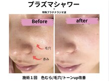 マリア(MALIA)/＃南森町エステ#赤み＃毛穴