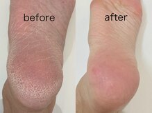 アンドエム(&M)/かかと角質ケア