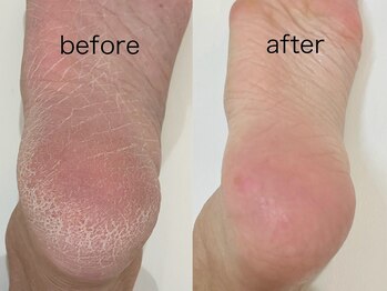 アンドエム(&M)/かかと角質ケア