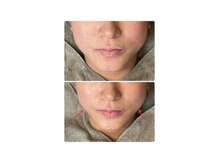 ラピスラズリ/レッドショット小顔リフトアップ