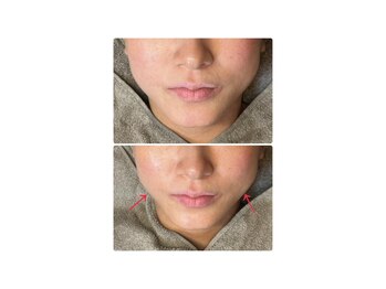 ラピスラズリ/レッドショット小顔リフトアップ