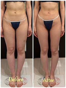 トータルボディセラピーハート(Heart)の写真/【サイズダウン続出★M→SSへ★戻らないスリム足を作る美脚バンテージ】下半身デブ・美脚・むくみ・小尻◎