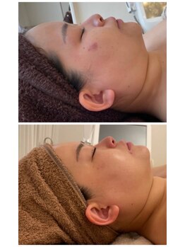 美人バスト 豊橋店/小顔症例【小顔/ フェイシャル】