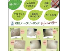 サロンドロキシー (Salon de Roxy)/ハーブピーリング(背中)