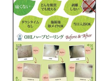 サロンドロキシー (Salon de Roxy)/ハーブピーリング(背中)