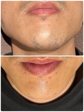 アネル オム 新都心店(ANEL HOMME)/痛みを抑えて効果大◎！