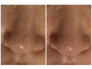 リラキュート(Rela Cute)/鼻の毛穴汚れも綺麗に