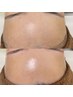 【WAX脱毛×艶肌】美肌フェイシャルワックス◎産毛＆角質ケアで水光肌へ