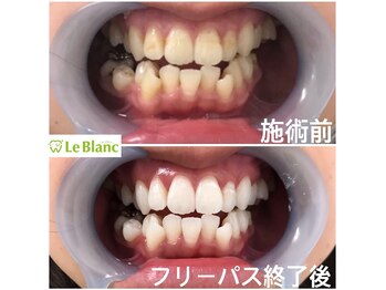 ルブラン 奈良店(Le Blanc)/白い歯！維持しましょう！