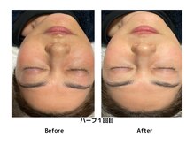 トトノエ プラス 新横浜店(TOTONOE+)/ハーブピーリング/ニキビ/肌ケア