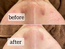 フェリス(Feliz)/ハイドロピーリング毛穴洗浄