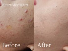 ワン(One)/頑固ニキビも美容鍼なら変わる！