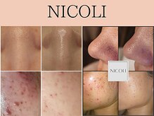 ニコリ(NICOLI)