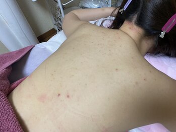 スキンケアスタジオ アコ 新宿店(Aco)/グリーンピールボディ１Day前