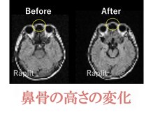 ラプリボヤージュ 藤沢店(Raplit)/ 隆鼻＋輪郭矯正40分7回