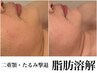 【たるみ改善/小顔/二重顎卒業】脂肪分解10ml導入　120分