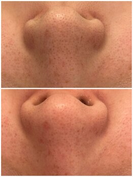 メゾンリュバン 梅田店(Maison Ruban)/毛穴洗浄|毛穴ケア