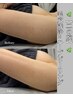【2回目以降の方】『二の腕のブツブツはハーブピーリングで改善できる』