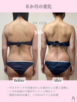 プラスワンビューティテン 新大阪店(Plus One Beauty)/ボディ/ハイパーナイフ/痩身