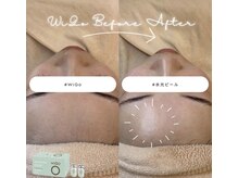 クロエココ(Chloe.cocoo)の雰囲気（《水光肌でツヤ肌へ》剥けない浸透型ピーリングダウンタイム無）