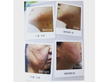 コンフォート 爽快 千里山店(COMFORT)の雰囲気(お肌のお悩み全般にハーブピーリング一度お試しください!)