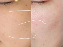 アモール(AMOR)/最新♪光フェイシャル