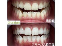 ルブラン 奈良店(Le Blanc)/憧れの白い歯！