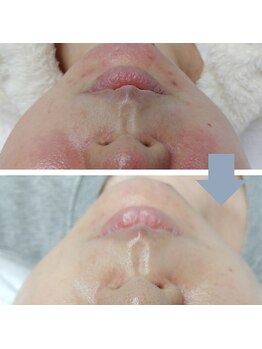 レベンディス(LEVENDIS)/ララピール