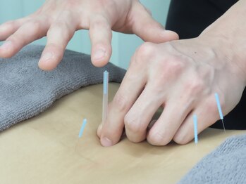 アロハ整骨院はりきゅう院の写真/身体のつぼや経路を刺激◎鍼灸施術で痛みの原因に直接アプローチし、身体の不調を根本改善!桜台駅徒歩3分!