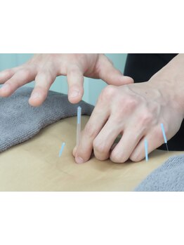 鍼灸施術を受けたい