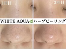 ホワイトアクア 浜松店(WHITE AQUA)/ハーブピーリング/ニキビケア