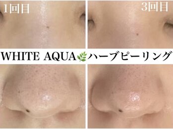 ホワイトアクア 浜松店(WHITE AQUA)/ハーブピーリング/ニキビケア