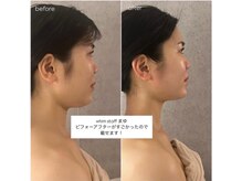 ウィム(whim)の雰囲気（一度でここまでの変化。ハンドだけでここまで変わります。）