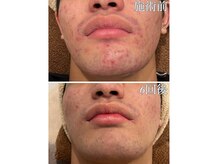 ビューティー アディクト(Beauty addict)の雰囲気（肌質改善【VOS サロンケア】ニキビ、シミ、シワ、くすみ改善に）