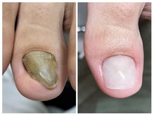 フレッシュフット(FreshFoot)/きれいな人工爪で爪を育成★