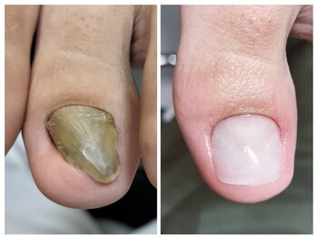 フレッシュフット(FreshFoot)/きれいな人工爪で爪を育成★