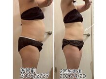 クールスパ(COOL SPA)/40代女性 お腹症例