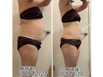 クールスパ(COOL SPA)/40代女性 お腹症例