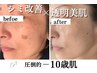 【人気No.1】シミピンポイントケア×お顔全体の透明美肌ケア¥5500(三島)