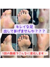 長岡巻き爪矯正センター/フットケアビフォーアフター