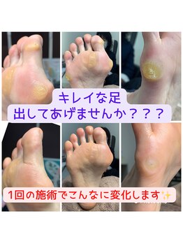 長岡巻き爪矯正センター/フットケアビフォーアフター