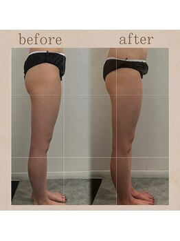 サロン ド ブラン アオヤマ(Salon de BLANC AOYAMA)/痩身メニューbefore・after